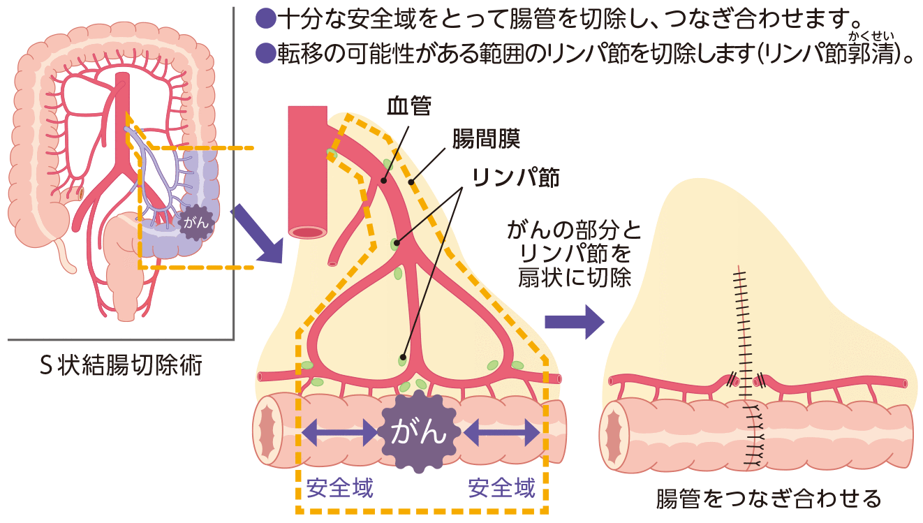 結腸がんの手術(例)