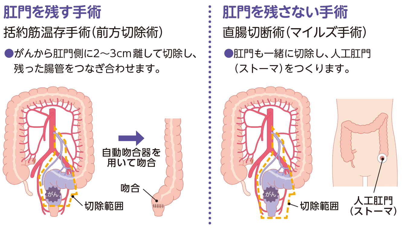 直腸がんの手術(例)