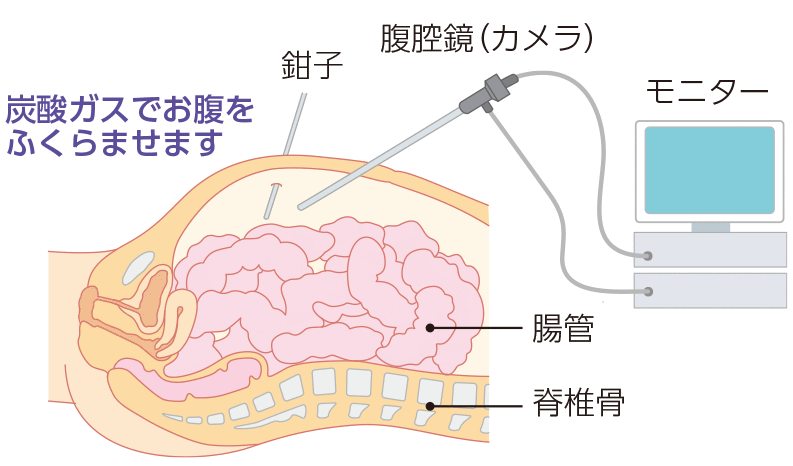 腹腔鏡下手術
