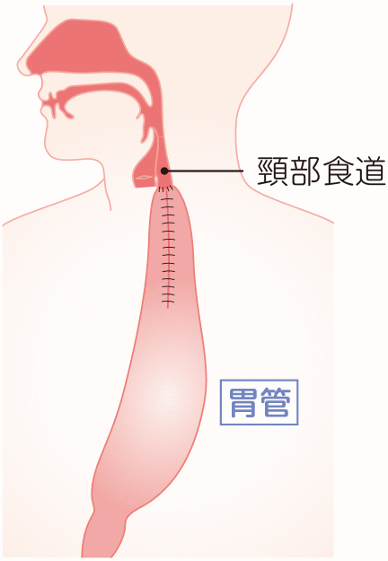 食道の再建