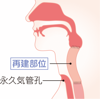 食道の再建