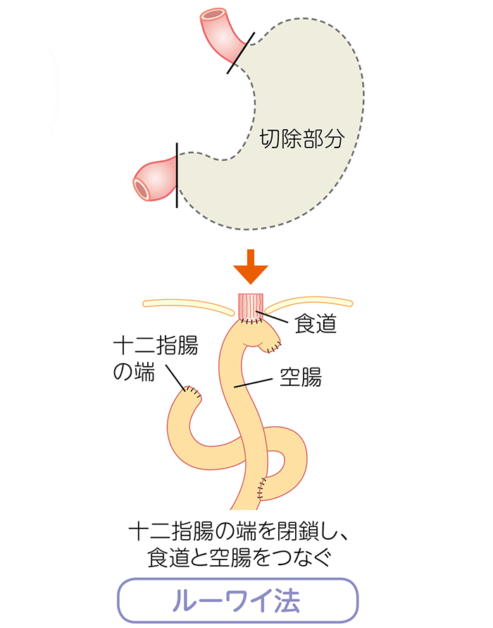 胃全摘術
