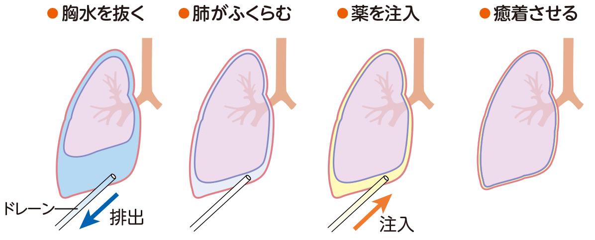 胸膜癒着術