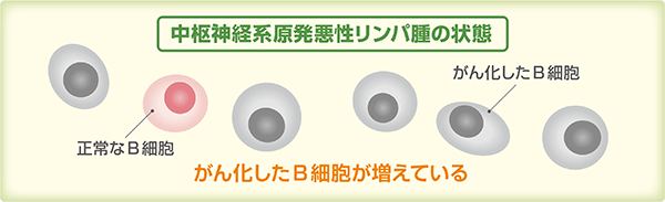 リンパ腫