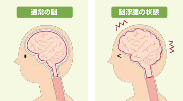脳腫瘍