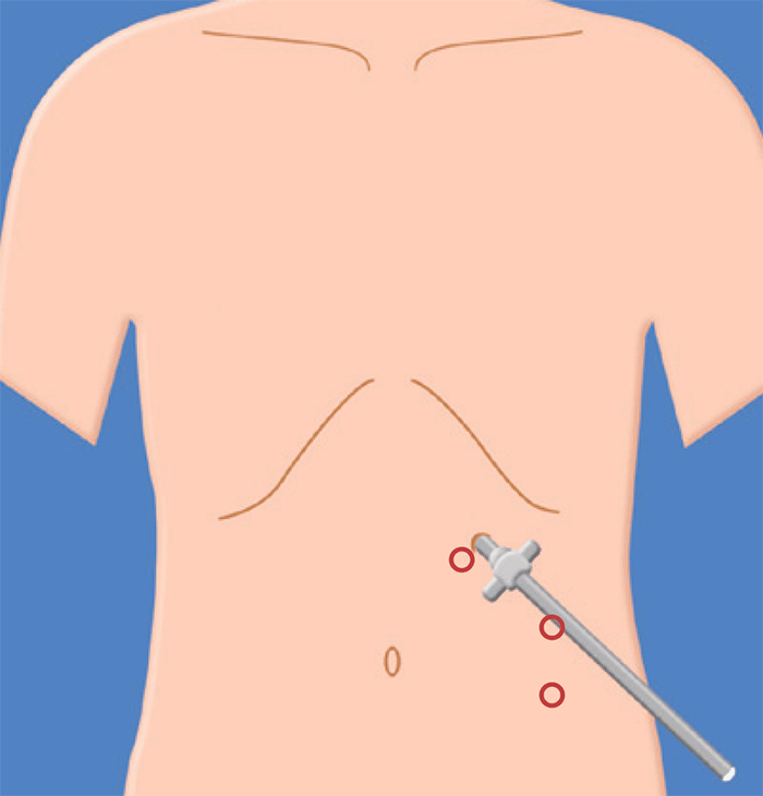 腹腔鏡下手術