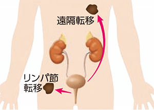 転移性がん