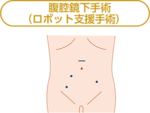 腹腔鏡下手術(ロボット支援手術)