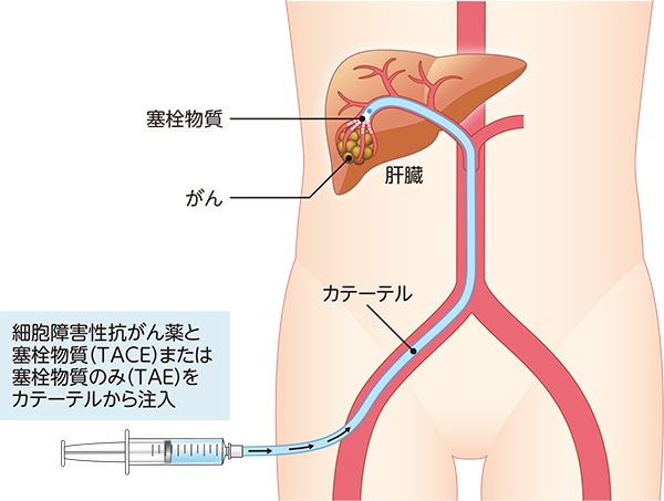 肝動脈塞栓療法(TAE)