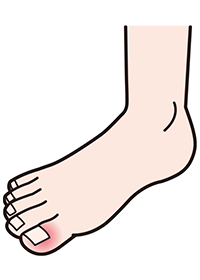 6週目頃~・爪のまわりの炎症