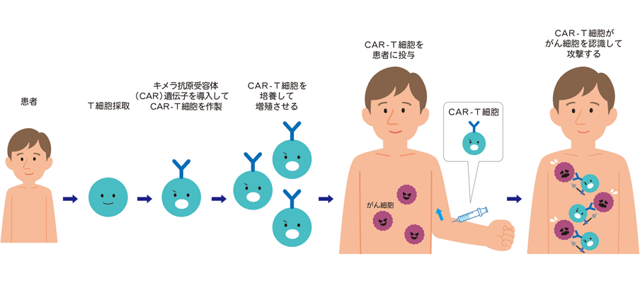 エフェクターT細胞療法(CAR-T細胞療法)